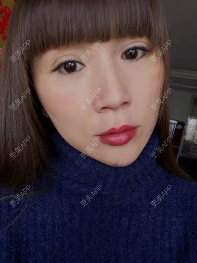 更美 - 更美用户i6Iy8EYag5的除皱经验 | 拉皮 | 小切口手术提升 | SMAS除皱手术 | 祛皱 | 除皱