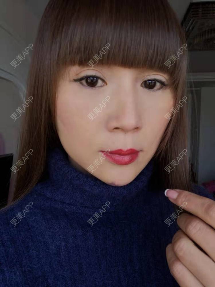 更美 - 更美用户i6Iy8EYag5的除皱经验 | 拉皮 | 小切口手术提升 | SMAS除皱手术 | 祛皱 | 除皱
