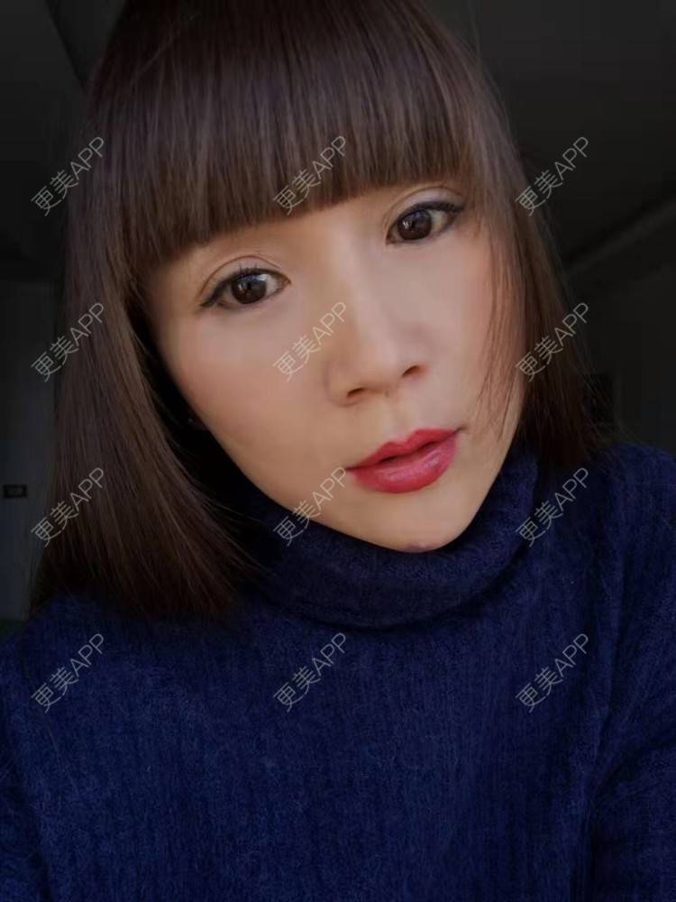 更美 - 更美用户i6Iy8EYag5的除皱经验 | 拉皮 | 小切口手术提升 | SMAS除皱手术 | 祛皱 | 除皱
