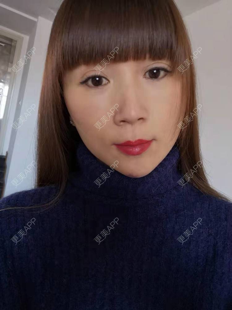 更美 - 更美用户i6Iy8EYag5的除皱经验 | 拉皮 | 小切口手术提升 | SMAS除皱手术 | 祛皱 | 除皱
