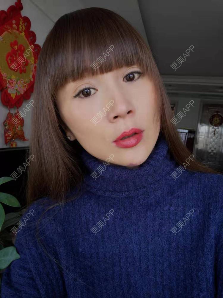 更美 - 更美用户i6Iy8EYag5的除皱经验 | 拉皮 | 小切口手术提升 | SMAS除皱手术 | 祛皱 | 除皱