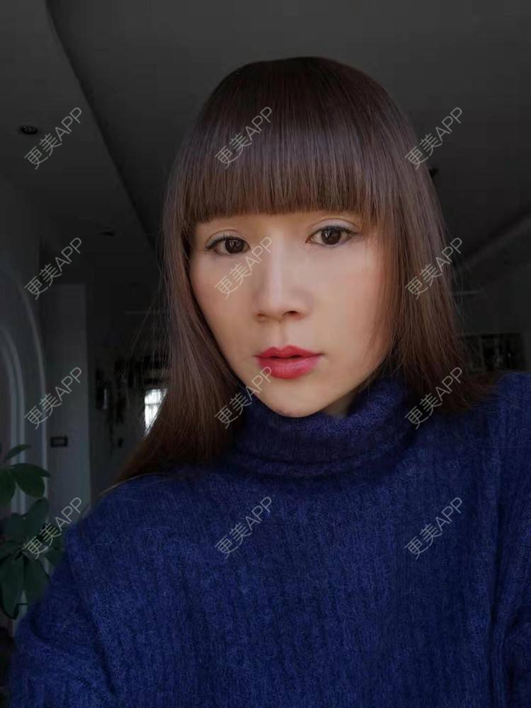 更美 - 更美用户i6Iy8EYag5的除皱经验 | 拉皮 | 小切口手术提升 | SMAS除皱手术 | 祛皱 | 除皱