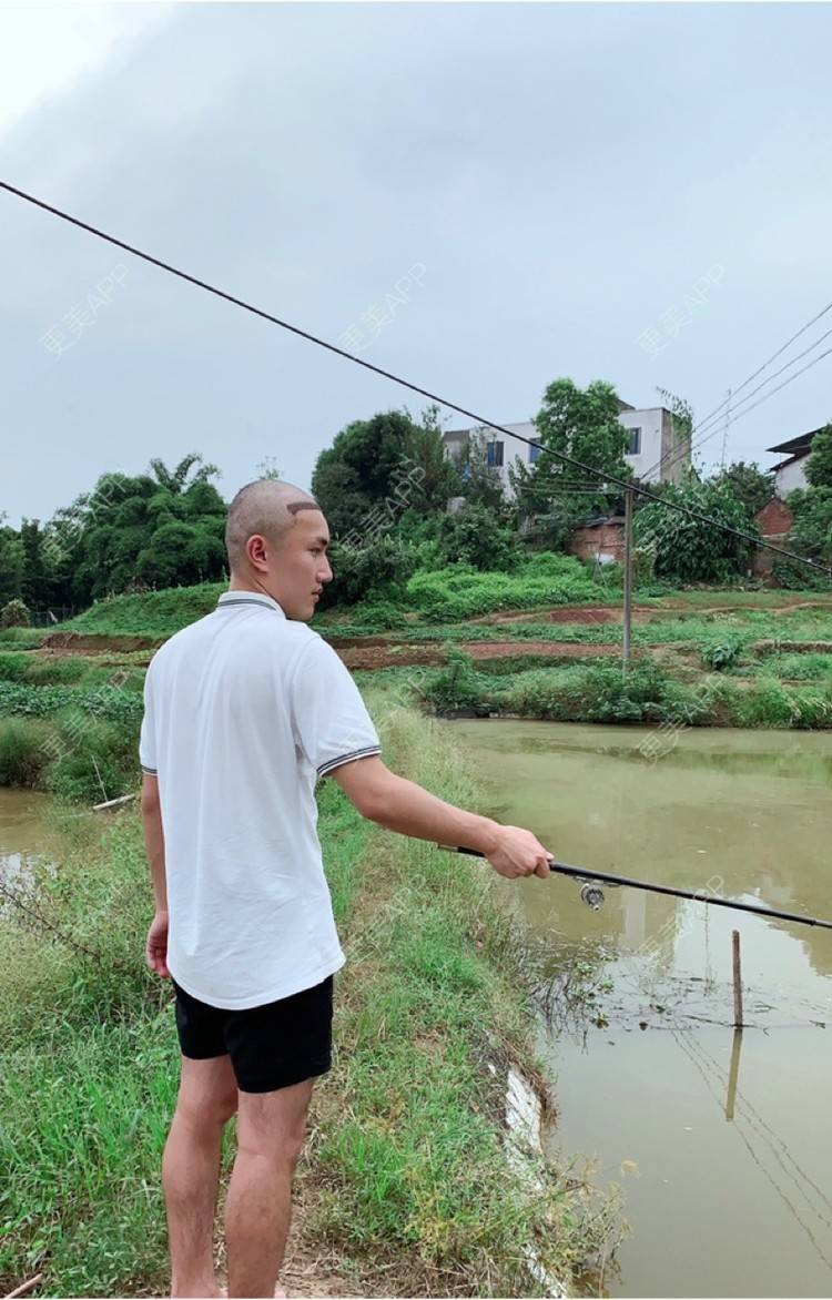 更美 - D调··的植发际线经验 | 植发际线 | 成都