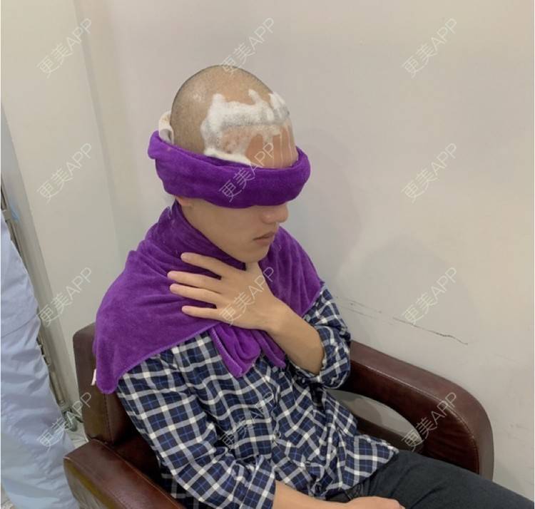 更美 - D调··的植发际线经验 | 植发际线 | 成都