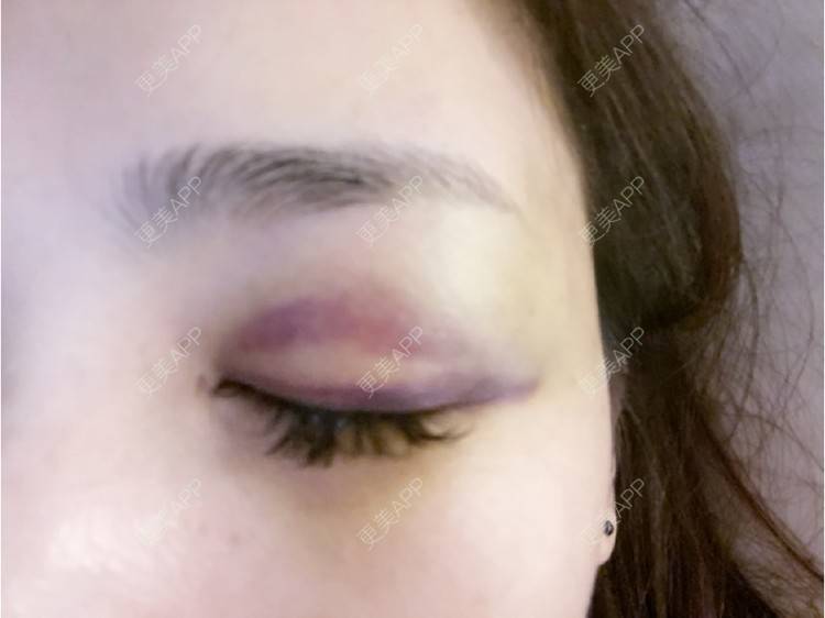 更美 - _ViViLee的自体脂肪丰太阳穴经验 | 自体脂肪丰太阳穴 | 自体脂肪垫眉弓 | 自体脂肪丰额头 | 上海