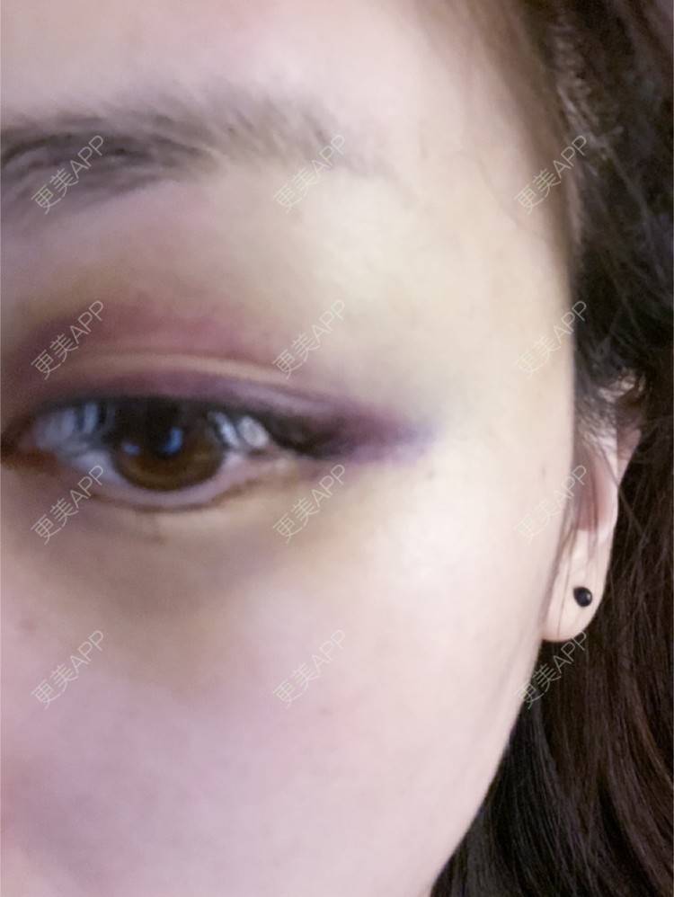 更美 - _ViViLee的自体脂肪丰太阳穴经验 | 自体脂肪丰太阳穴 | 自体脂肪垫眉弓 | 自体脂肪丰额头 | 上海