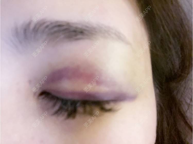 更美 - _ViViLee的自体脂肪丰太阳穴经验 | 自体脂肪丰太阳穴 | 自体脂肪垫眉弓 | 自体脂肪丰额头 | 上海