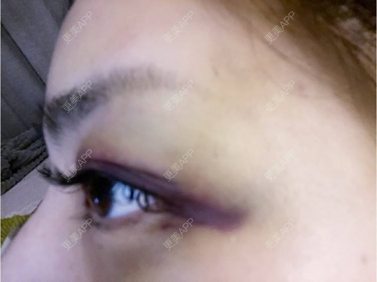 更美 - _ViViLee的自体脂肪丰太阳穴经验 | 自体脂肪丰太阳穴 | 自体脂肪垫眉弓 | 自体脂肪丰额头 | 上海