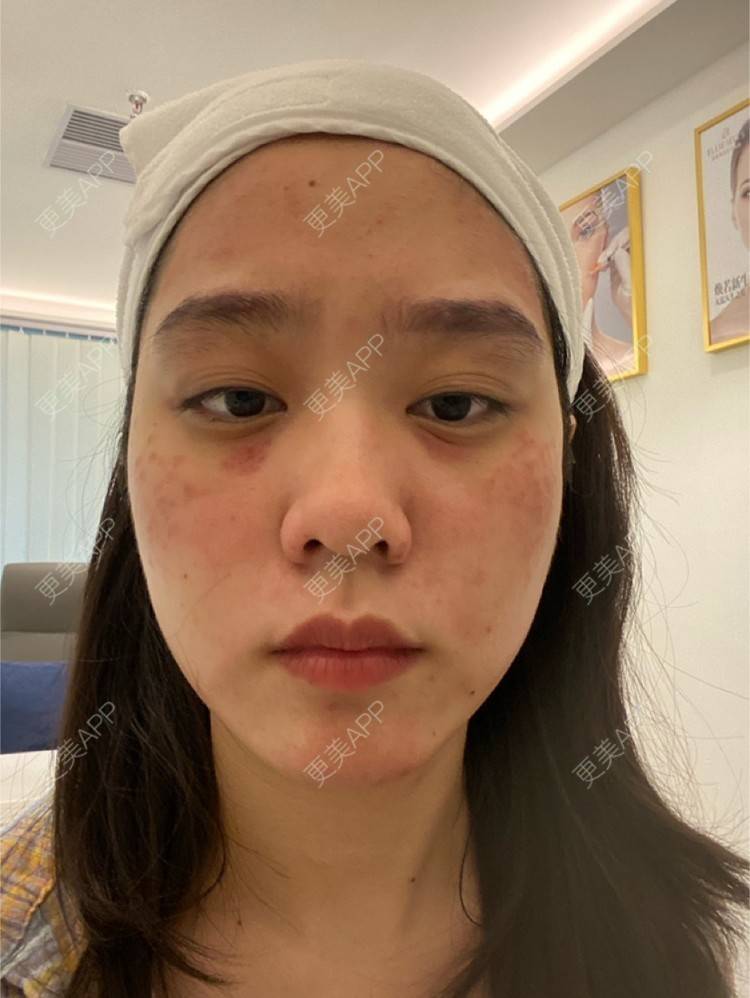 更美 - 更美用户Z50yfz3F6O的激光洗眉经验 | 广州 | 激光洗眉