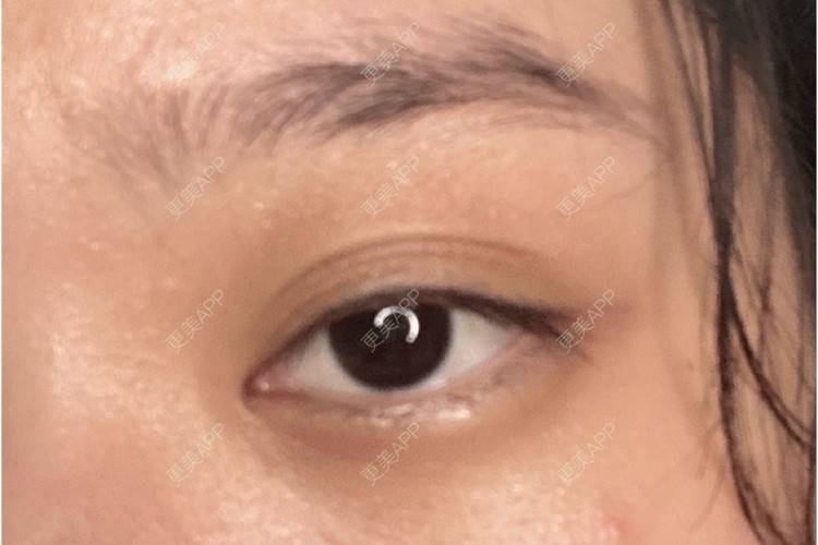 更美 - 更美用户Z50yfz3F6O的激光洗眉经验 | 广州 | 激光洗眉