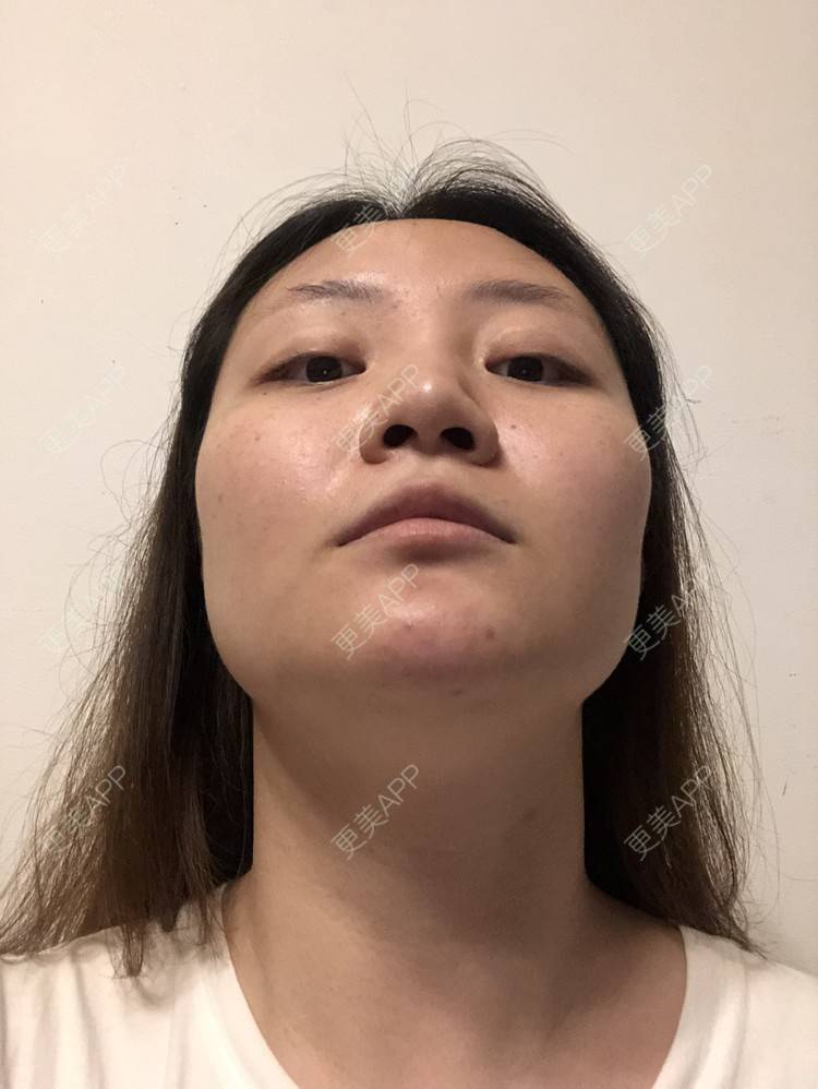 更美 - 想磨骨的飘飘的颧骨颧弓经验 | 视频日记 | 颧骨内推 | 颧骨颧弓整形 | 下颌角切除 | V脸套餐 | 上海