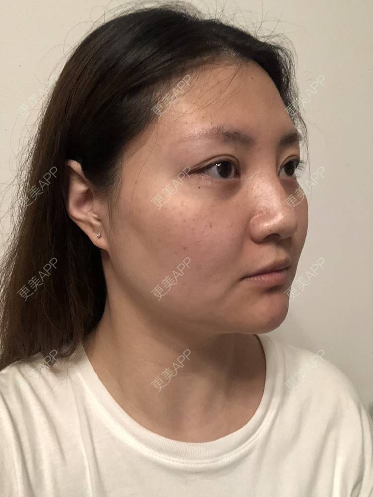 更美 - 想磨骨的飘飘的颧骨颧弓经验 | 视频日记 | 颧骨内推 | 颧骨颧弓整形 | 下颌角切除 | V脸套餐 | 上海