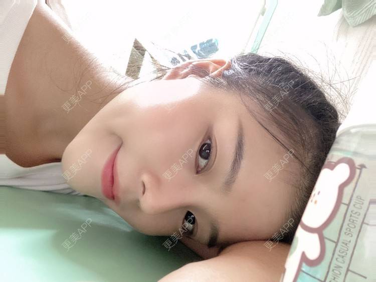 更美 - 芝芝妹妹的鼻部多项经验 | 鼻部多项 | 手术缩鼻头 | 重庆 | 鼻中隔软骨垫鼻头 | 鼻中隔软骨隆鼻 | 鼻小柱延长