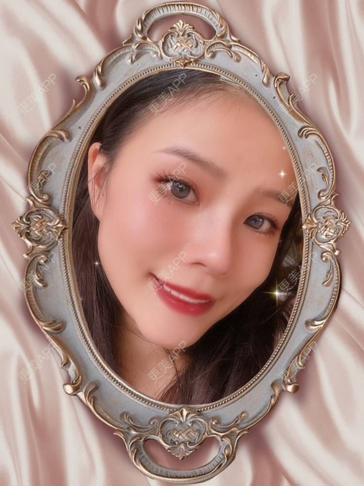 更美 - 芝芝妹妹的鼻部多项经验 | 鼻部多项 | 手术缩鼻头 | 重庆 | 鼻中隔软骨垫鼻头 | 鼻中隔软骨隆鼻 | 鼻小柱延长