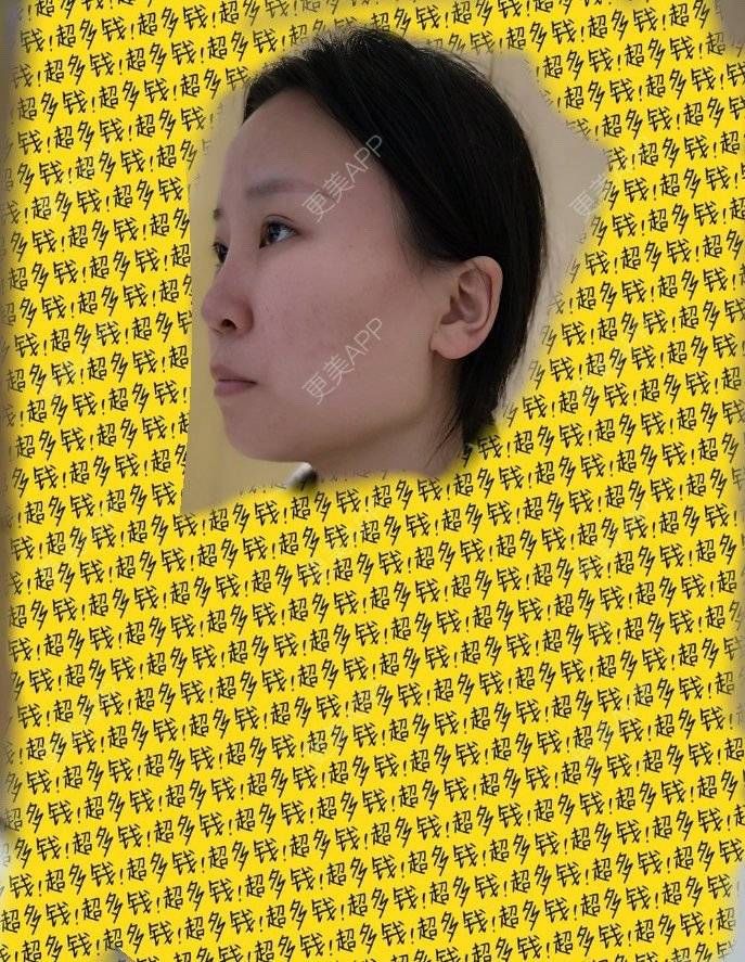 更美 - 桑迪niu的颧骨内推经验 | 颧骨内推 | 下颌角切除 | 上海