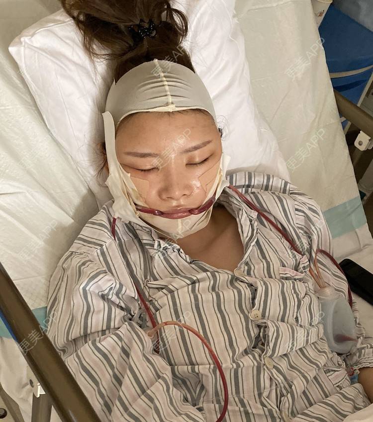 更美 - 桑迪niu的颧骨内推经验 | 颧骨内推 | 下颌角切除 | 上海