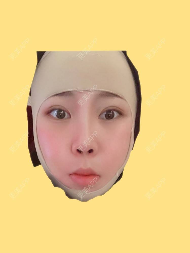 更美 - 桑迪niu的颧骨内推经验 | 颧骨内推 | 下颌角切除 | 上海