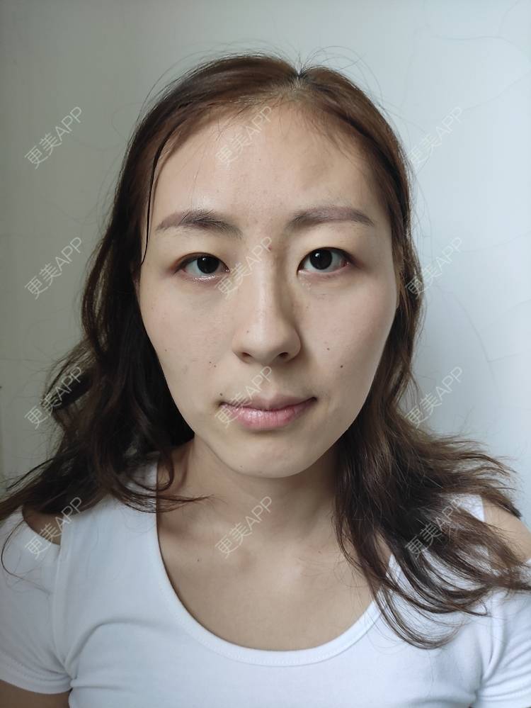 更美 - LULUMO莫的除皱瘦脸经验 | 除皱瘦脸 | 颧骨内推 | 颧弓降低 | 下颌角切除 | 上海