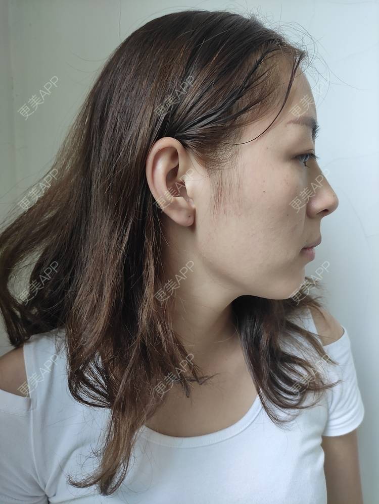 更美 - LULUMO莫的除皱瘦脸经验 | 除皱瘦脸 | 颧骨内推 | 颧弓降低 | 下颌角切除 | 上海
