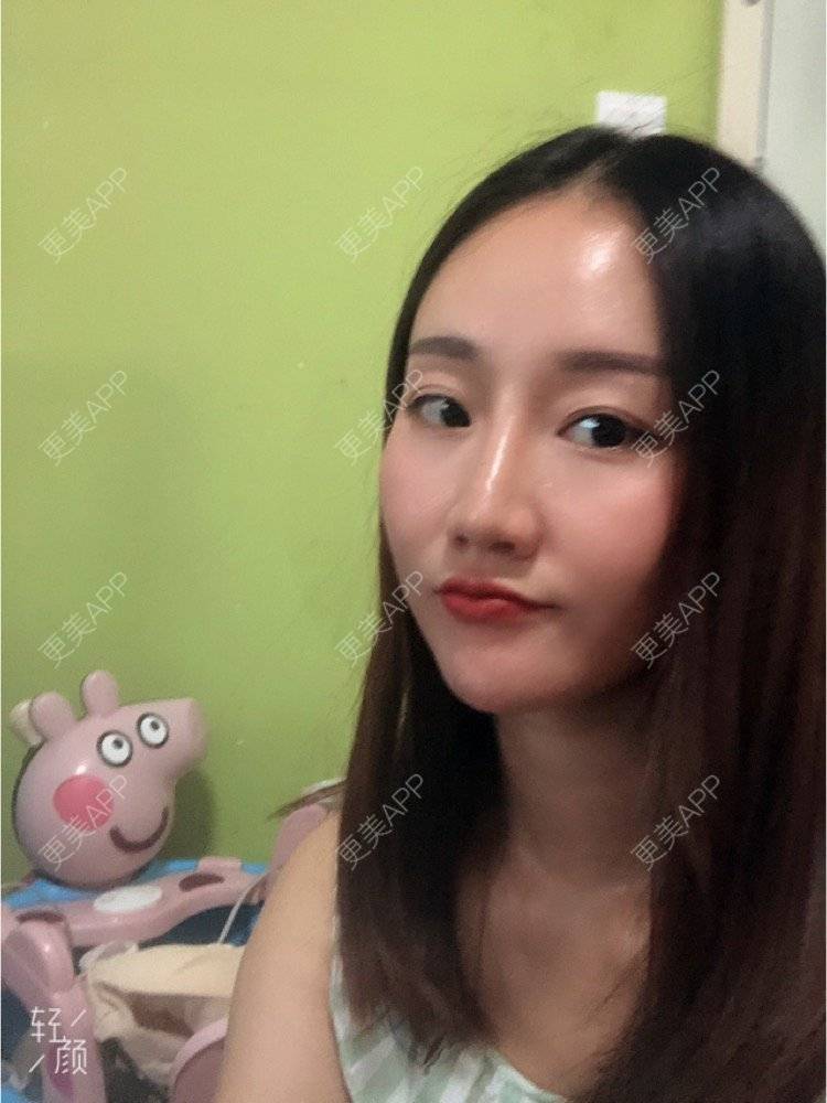 更美 - 更美用户KypVf5ovVE的点阵激光经验 | 上海 | 点阵激光