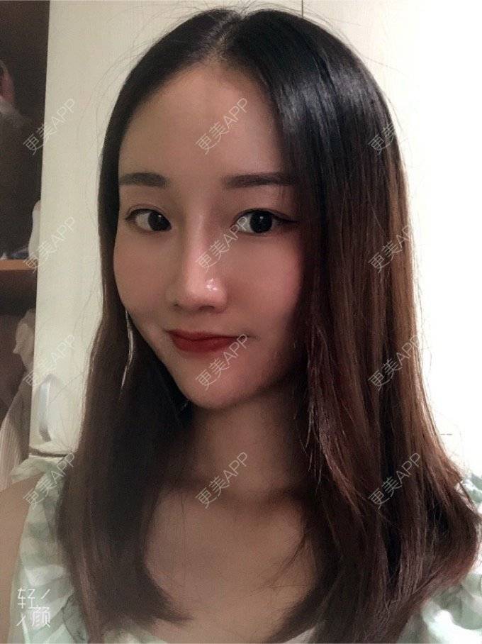 更美 - 更美用户KypVf5ovVE的点阵激光经验 | 上海 | 点阵激光