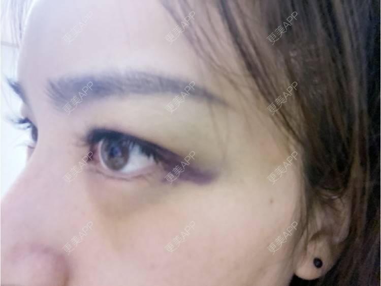 更美 - _ViViLee的自体脂肪丰太阳穴经验 | 自体脂肪丰太阳穴 | 自体脂肪垫眉弓 | 自体脂肪丰额头 | 上海