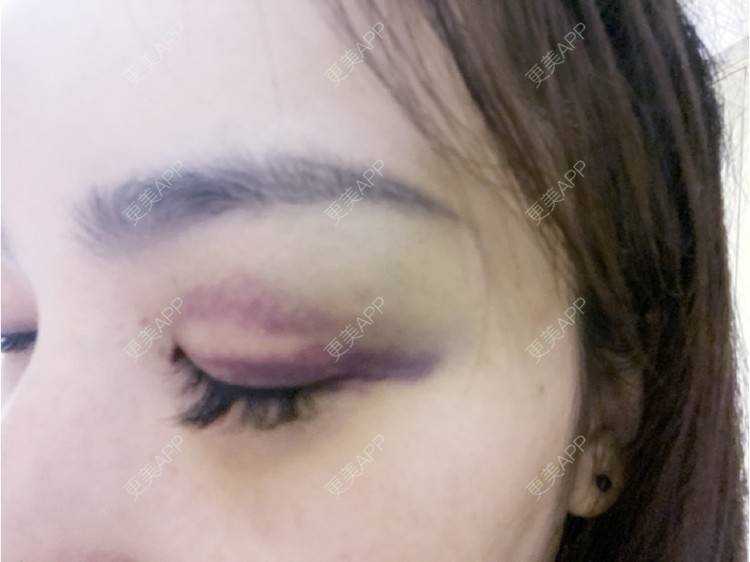 更美 - _ViViLee的自体脂肪丰太阳穴经验 | 自体脂肪丰太阳穴 | 自体脂肪垫眉弓 | 自体脂肪丰额头 | 上海