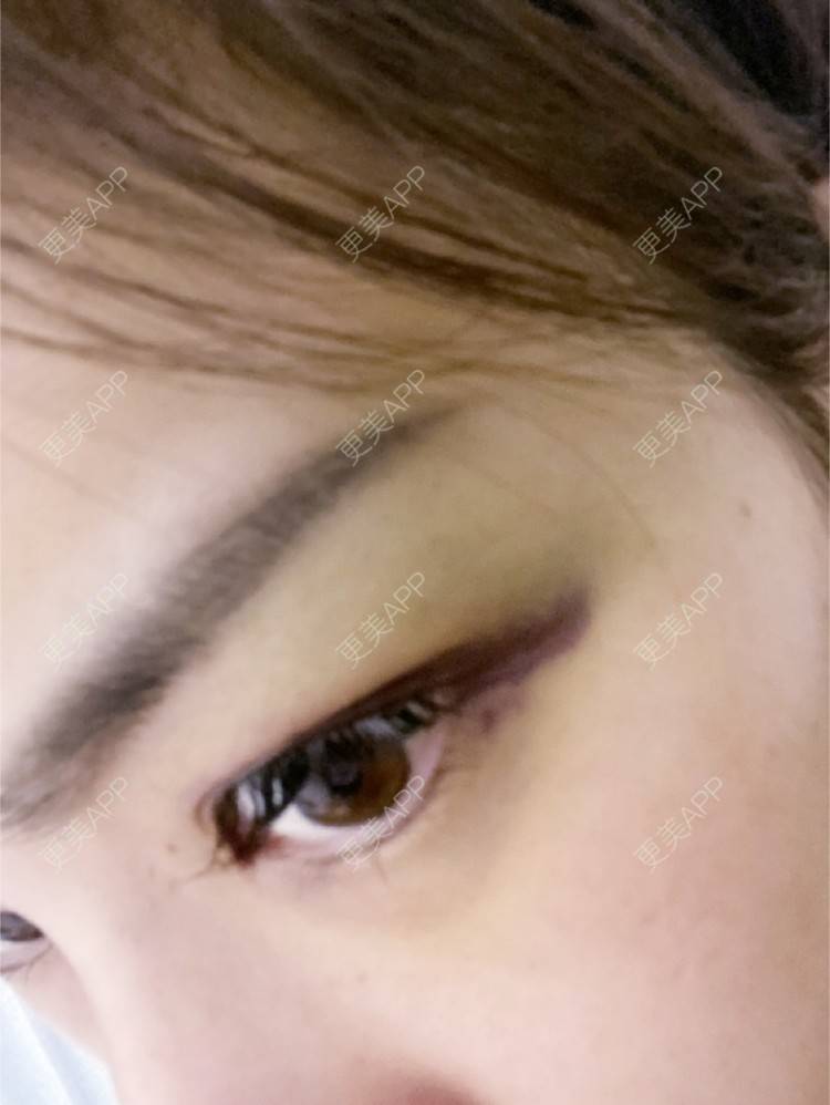 更美 - _ViViLee的自体脂肪丰太阳穴经验 | 自体脂肪丰太阳穴 | 自体脂肪垫眉弓 | 自体脂肪丰额头 | 上海