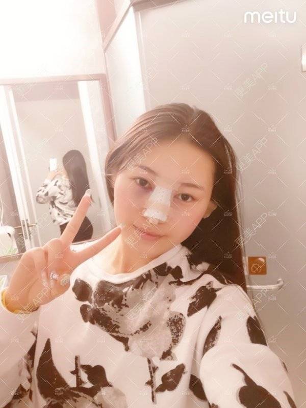 更美 - 更美用户W3Th6XhOzv的耳软骨隆鼻经验 | 耳软骨隆鼻 | 苏州