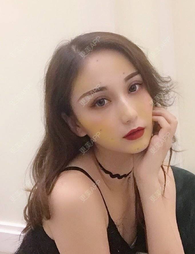 更美 - 更美用户iMDKsqhfhg的埋线提升经验 | 埋线提升 | 埋线除皱 | 除皱套餐 | 祛皱 | 抗衰紧致 | 武汉