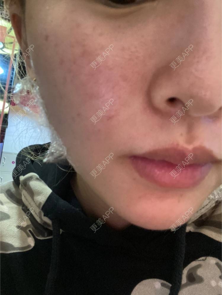 更美 - vhhdidj的注射塑形腿部经验 | 注射塑形腿部 | 重庆