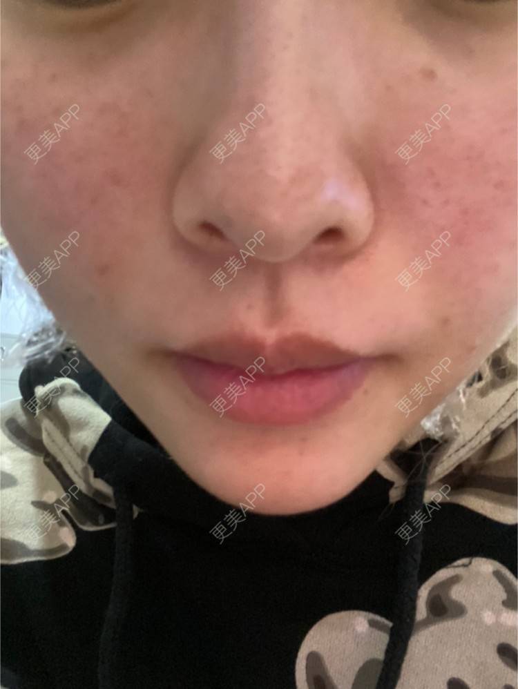 更美 - vhhdidj的注射塑形腿部经验 | 注射塑形腿部 | 重庆