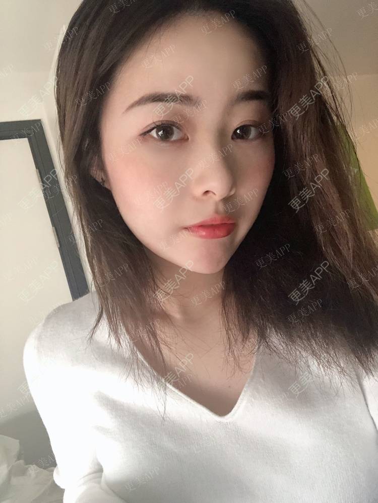 更美 - 豆豆0.0的鼻部多项经验 | 鼻部多项 | 鼻部膨体假体取出 | 肋软骨隆鼻 | 成都 | 长鼻矫正 | 自体肋软骨垫鼻基底