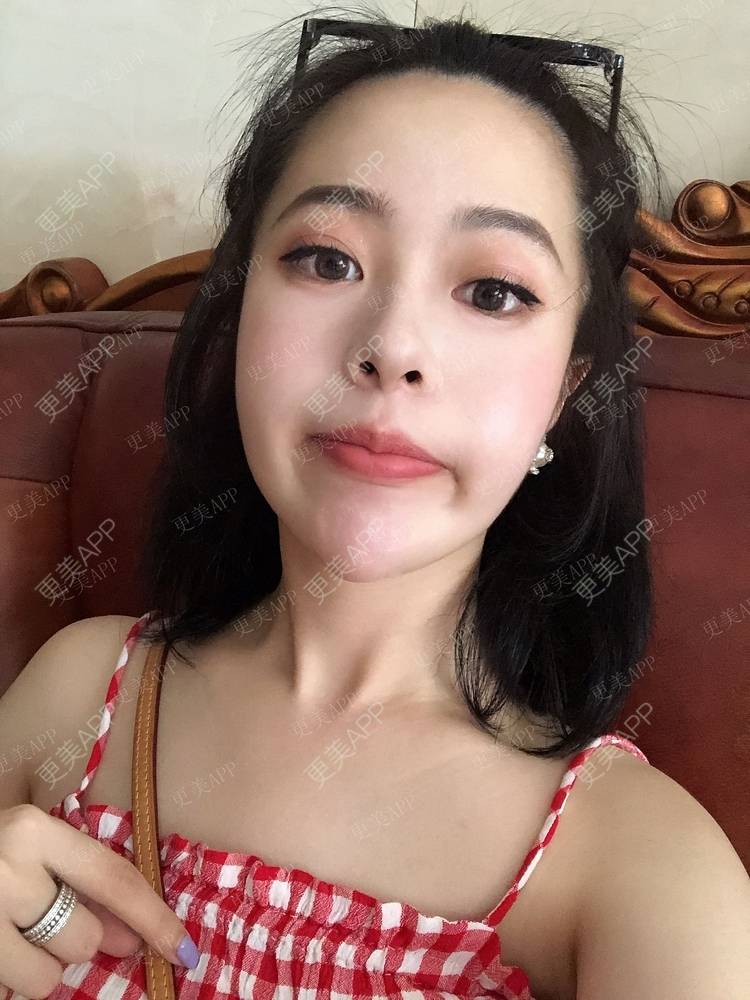 更美 - 豆豆0.0的鼻部多项经验 | 鼻部多项 | 鼻部膨体假体取出 | 肋软骨隆鼻 | 成都 | 长鼻矫正 | 自体肋软骨垫鼻基底