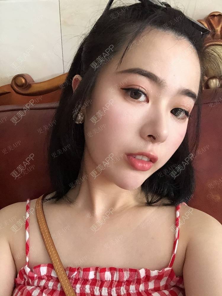 更美 - 豆豆0.0的鼻部多项经验 | 鼻部多项 | 鼻部膨体假体取出 | 肋软骨隆鼻 | 成都 | 长鼻矫正 | 自体肋软骨垫鼻基底