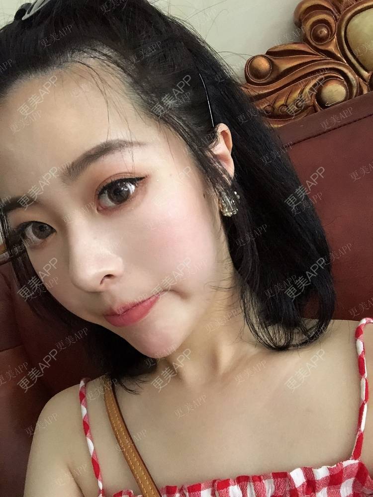 更美 - 豆豆0.0的鼻部多项经验 | 鼻部多项 | 鼻部膨体假体取出 | 肋软骨隆鼻 | 成都 | 长鼻矫正 | 自体肋软骨垫鼻基底