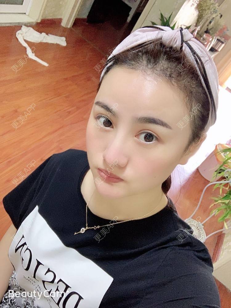 更美 - 更美用户tYzlahBO6T的植发际线经验 | 植发际线 | 深圳 | 毛发移植