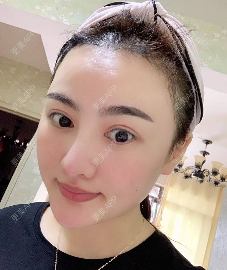 更美 - 更美用户tYzlahBO6T的植发际线经验 | 植发际线 | 深圳 | 毛发移植
