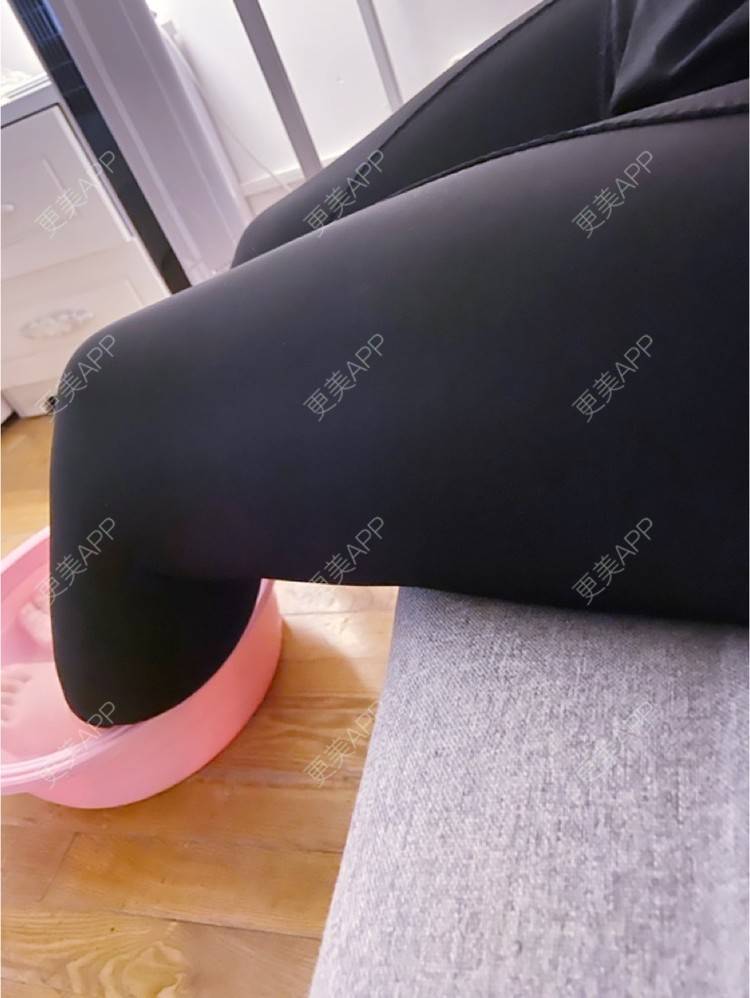更美 - _ViViLee的吸脂经验 | 吸脂瘦大腿 | 吸脂塑臀 | 超声溶脂瘦大腿 | 吸脂 | 上海 | 射频溶脂瘦大腿 | 光纤溶脂瘦大腿