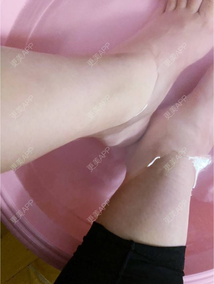 更美 - _ViViLee的吸脂经验 | 吸脂瘦大腿 | 吸脂塑臀 | 超声溶脂瘦大腿 | 吸脂 | 上海 | 射频溶脂瘦大腿 | 光纤溶脂瘦大腿