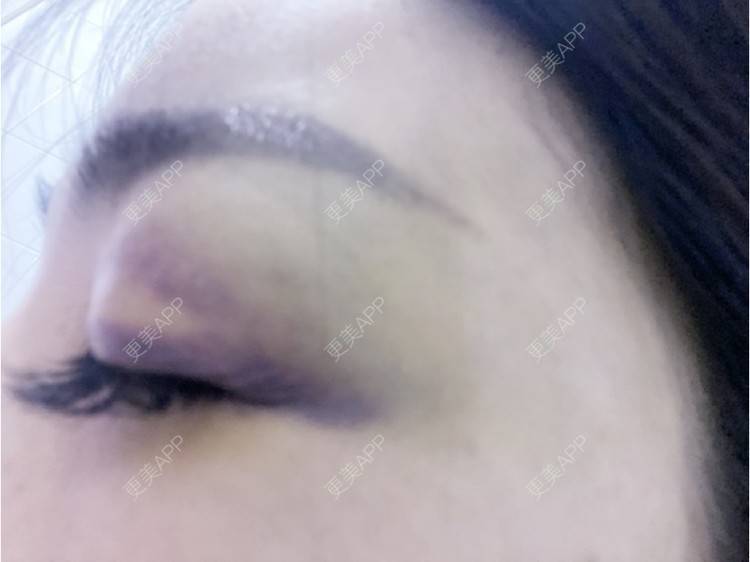 更美 - _ViViLee的自体脂肪丰太阳穴经验 | 自体脂肪丰太阳穴 | 自体脂肪垫眉弓 | 自体脂肪丰额头 | 上海