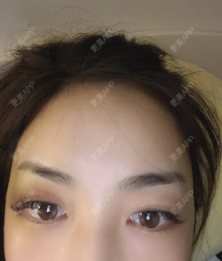 更美 - _ViViLee的自体脂肪丰太阳穴经验 | 自体脂肪丰太阳穴 | 自体脂肪垫眉弓 | 自体脂肪丰额头 | 上海