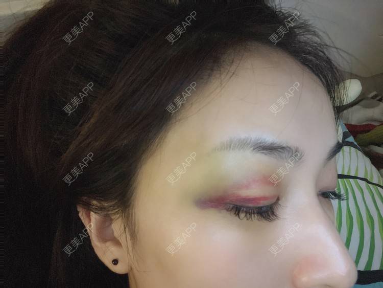 更美 - _ViViLee的自体脂肪丰太阳穴经验 | 自体脂肪丰太阳穴 | 自体脂肪垫眉弓 | 自体脂肪丰额头 | 上海