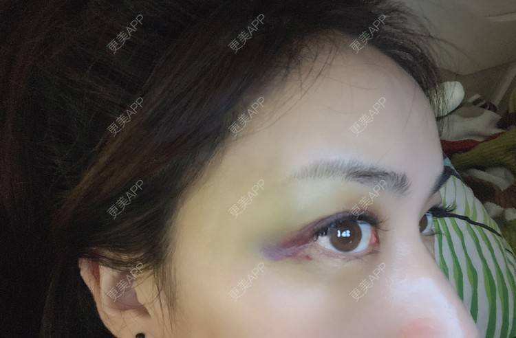 更美 - _ViViLee的自体脂肪丰太阳穴经验 | 自体脂肪丰太阳穴 | 自体脂肪垫眉弓 | 自体脂肪丰额头 | 上海