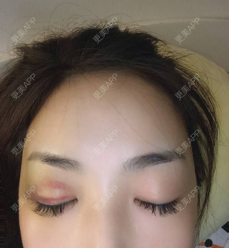 更美 - _ViViLee的自体脂肪丰太阳穴经验 | 自体脂肪丰太阳穴 | 自体脂肪垫眉弓 | 自体脂肪丰额头 | 上海