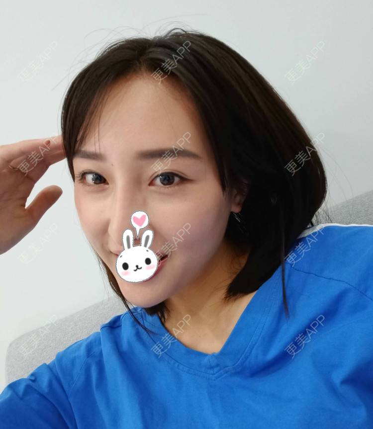 更美 - 更美用户1ieoNiY7aB的植发际线经验 | 北京 | 植发际线 | 毛发移植