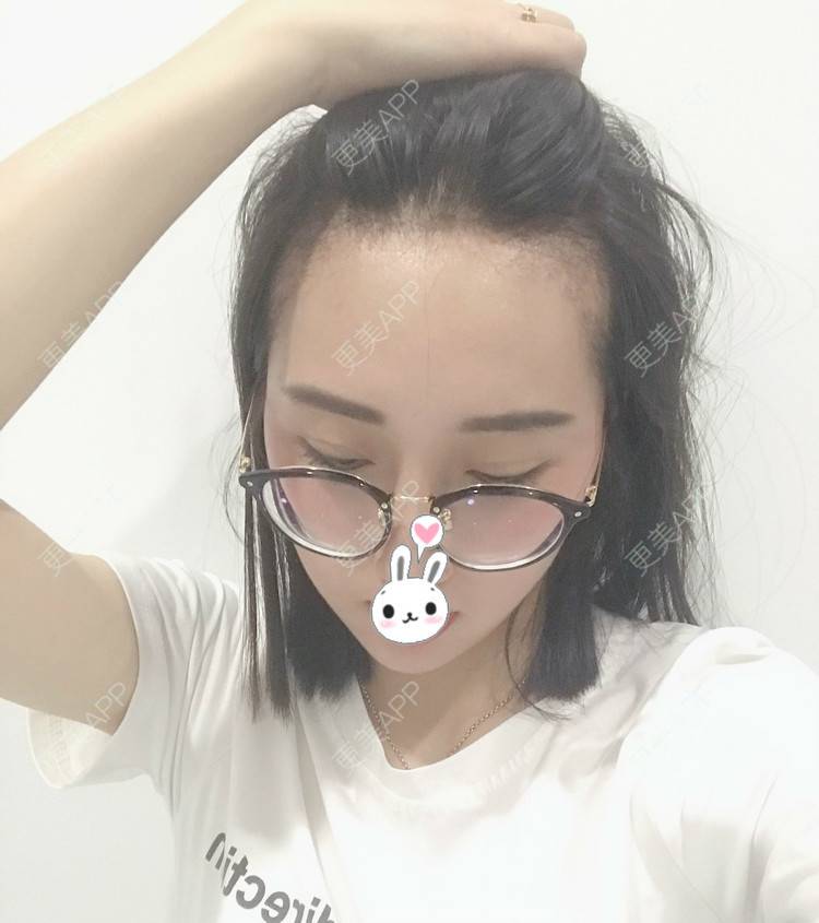 更美 - 更美用户1ieoNiY7aB的植发际线经验 | 北京 | 植发际线 | 毛发移植