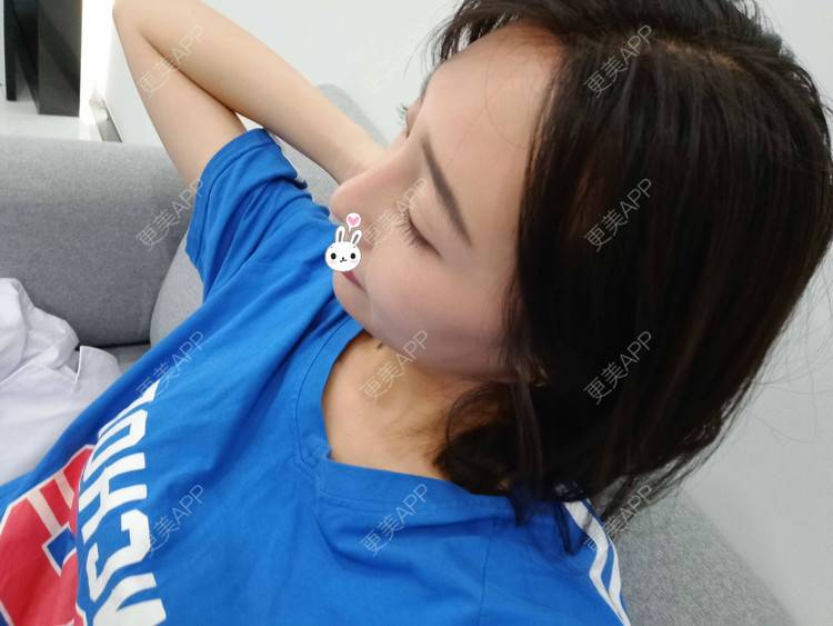 更美 - 更美用户1ieoNiY7aB的植发际线经验 | 北京 | 植发际线 | 毛发移植