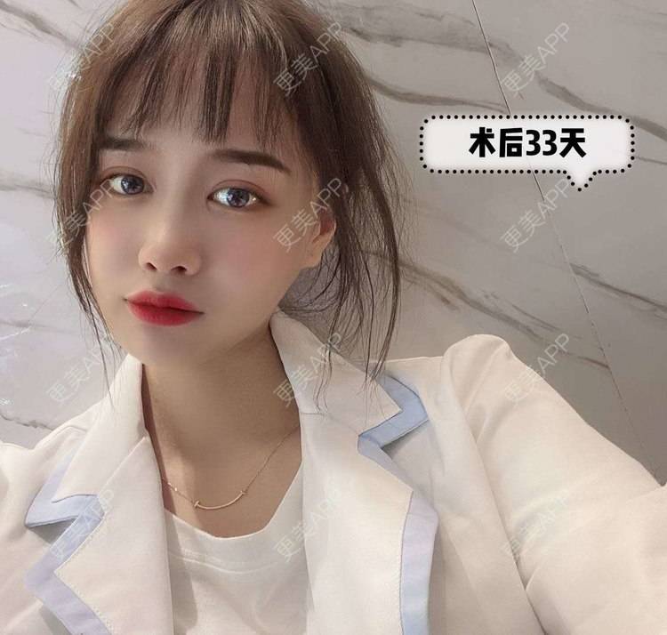更美 - 杭州瑞晶整形的隆鼻经验 | 杭州 | 全切双眼皮 | 隆鼻