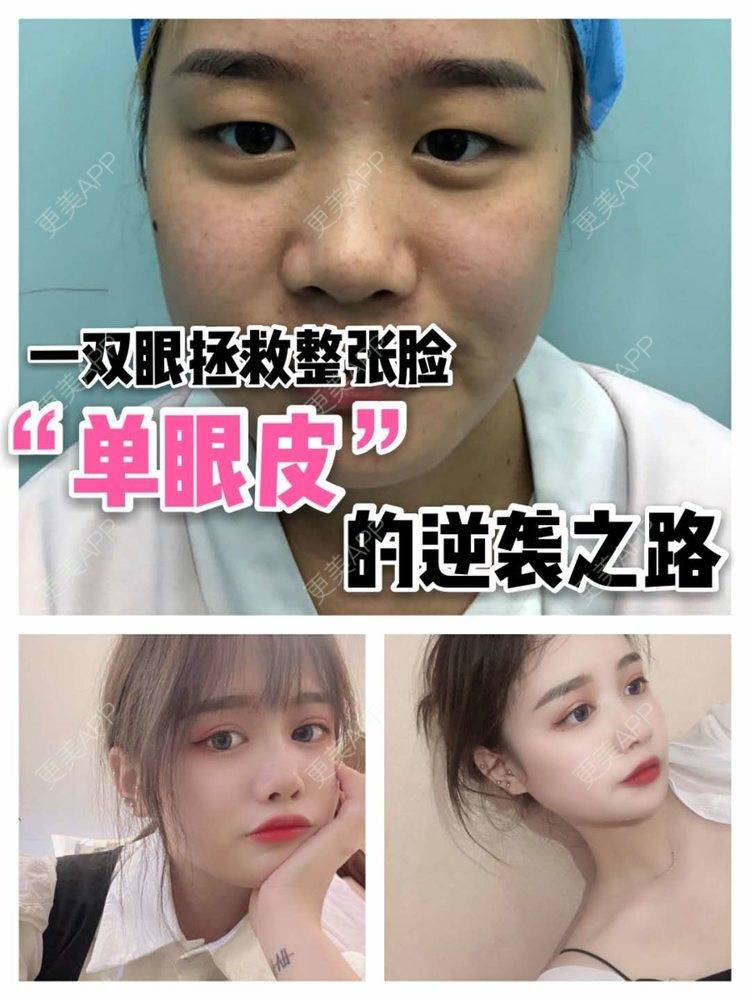 更美 - 杭州瑞晶整形的隆鼻经验 | 杭州 | 全切双眼皮 | 隆鼻